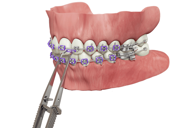 Traditional Orthodontics