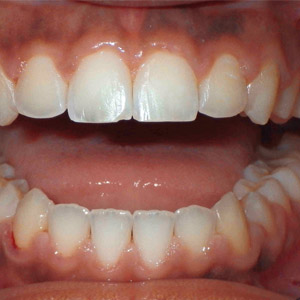 rivan_after_upper_occlusal