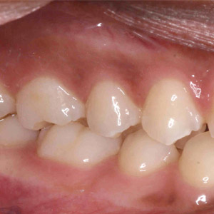rivan_before_lower_occlusal