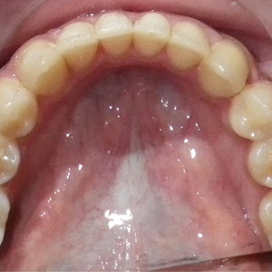 rivan_after_lower_occlusal