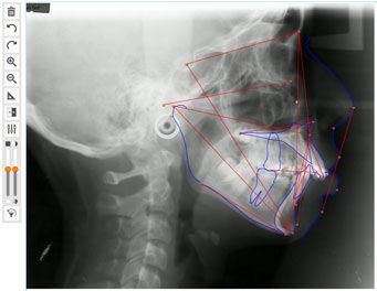 digital-cephalometric-analysis